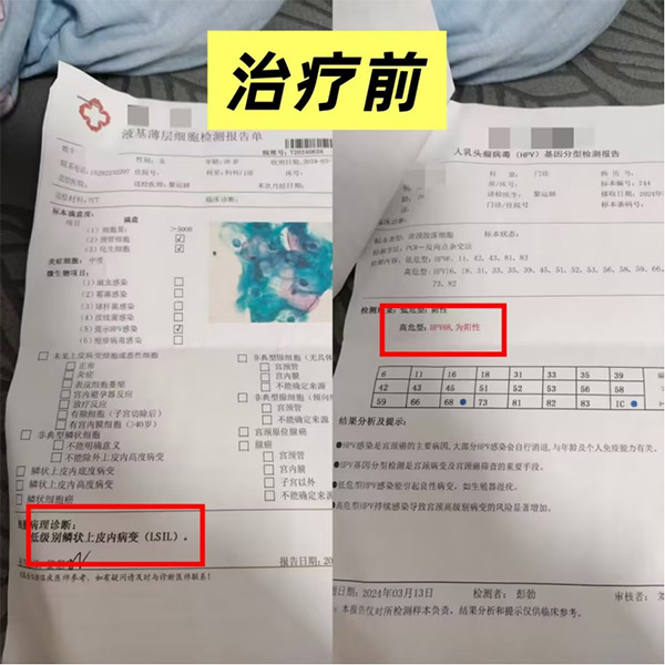 刘真淋医生医案——HPV感染宫颈癌前病变1级转阴治疗前