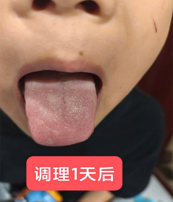 儿推师袁天好小儿积食医案-调理一天后