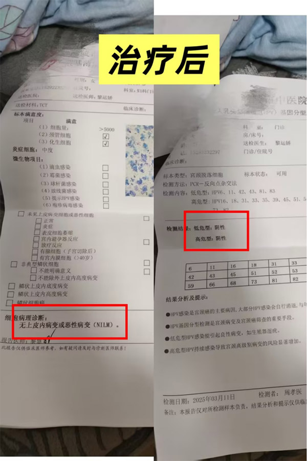 刘真淋医生医案——HPV感染宫颈癌前病变1级转阴治疗后