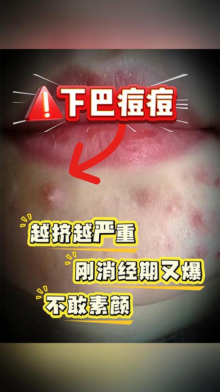下巴长痘